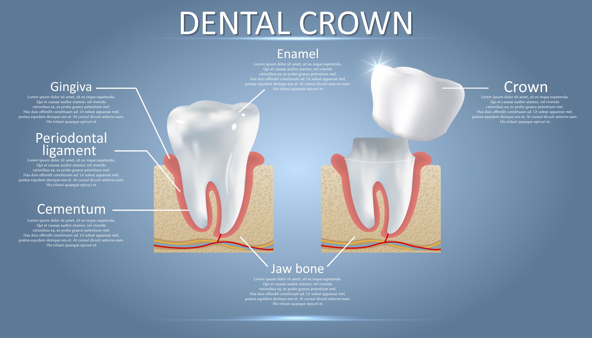 dental crown