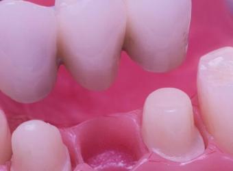 Bridging the Gap: Understanding Dental Bridges in Restorative Dentistry