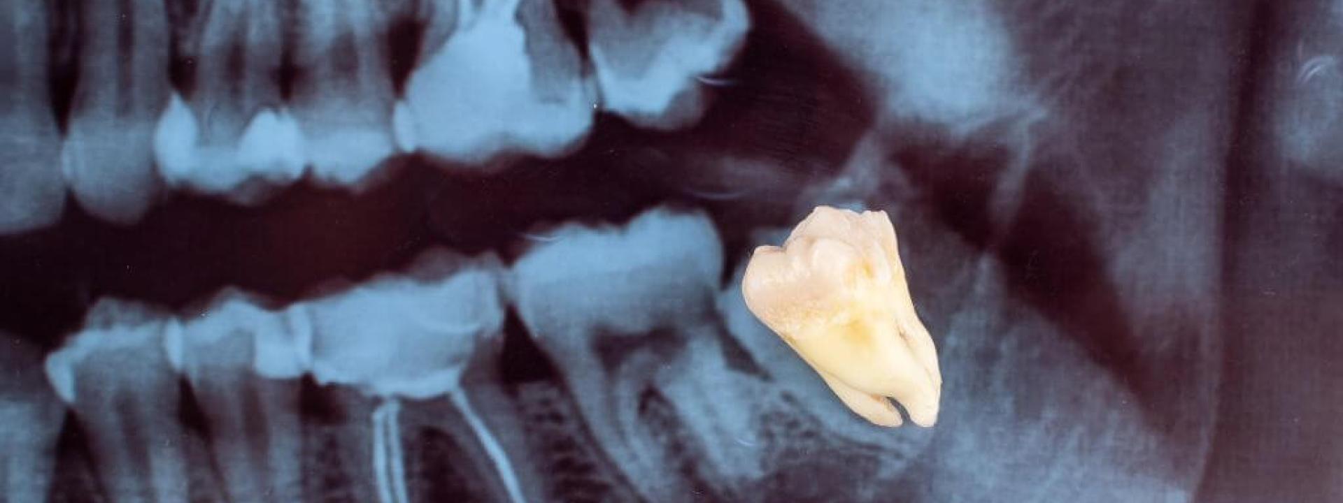 Dental x-ray image of a wisdom tooth