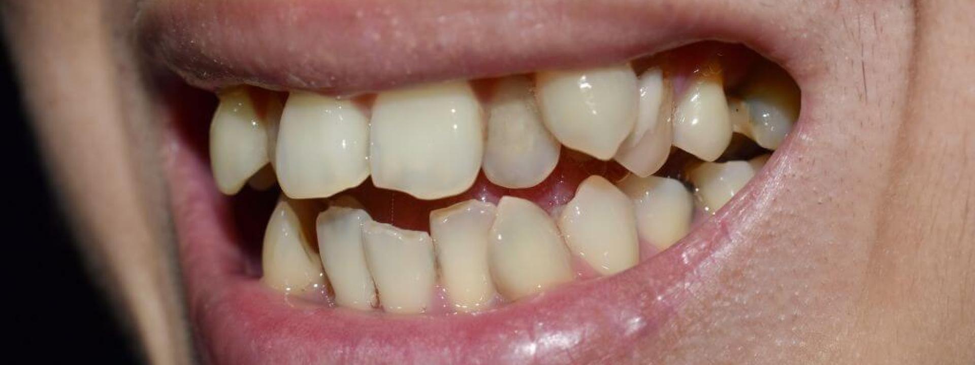 Hyperdontia in human dental services. Hyperdontia in human dental services.